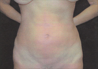 Upper and Lower Abdominal Liposuction Female - Next Day