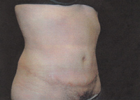 Upper and Lower Abdominal Liposuction Female - Next Day