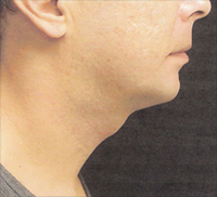 Chin and Neck Liposuction Female - Next Day