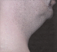 Chin and Neck Liposuction Female - Before