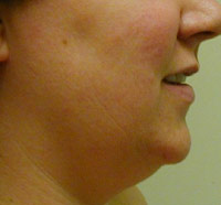 Chin and Neck Liposuction Female - Before