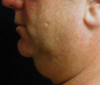 Chin and Neck Liposuction Male - Before
