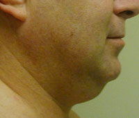 Chin and Neck Liposuction Male - Before