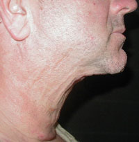 Chin and Neck Liposuction Male - Next Day