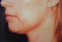 Chin Lift Female - 4 Weeks Later