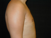 Male Breast Liposuction Male - Next Day