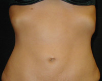 Upper and Lower Abdominal Liposuction Female - 1 Month Later