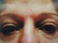 Upper Lower Eyelid Female - Before